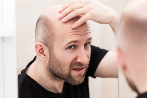 30 Reasons Why You Should Quit Smoking and Start Vaping - baldness